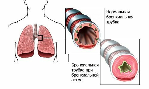 Частые уборки и стерильность - путь к астме для ребенка